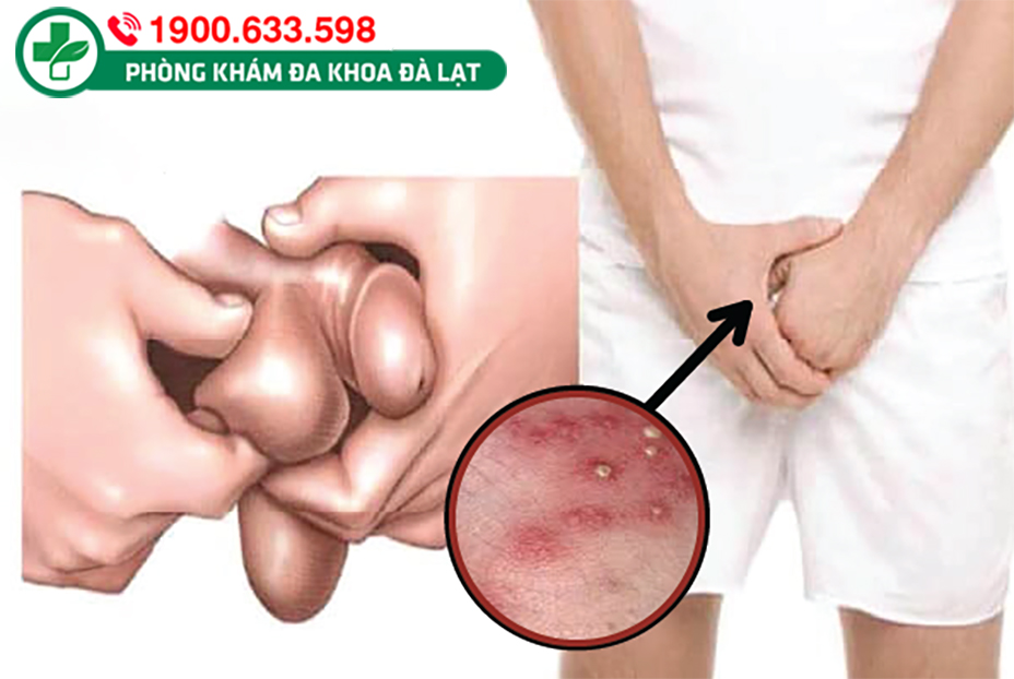 LÀM SAO ĐỂ KHẮC PHỤC TÌNH TRẠNG NỔI MỤN NGỨA VÙNG BÌU ?